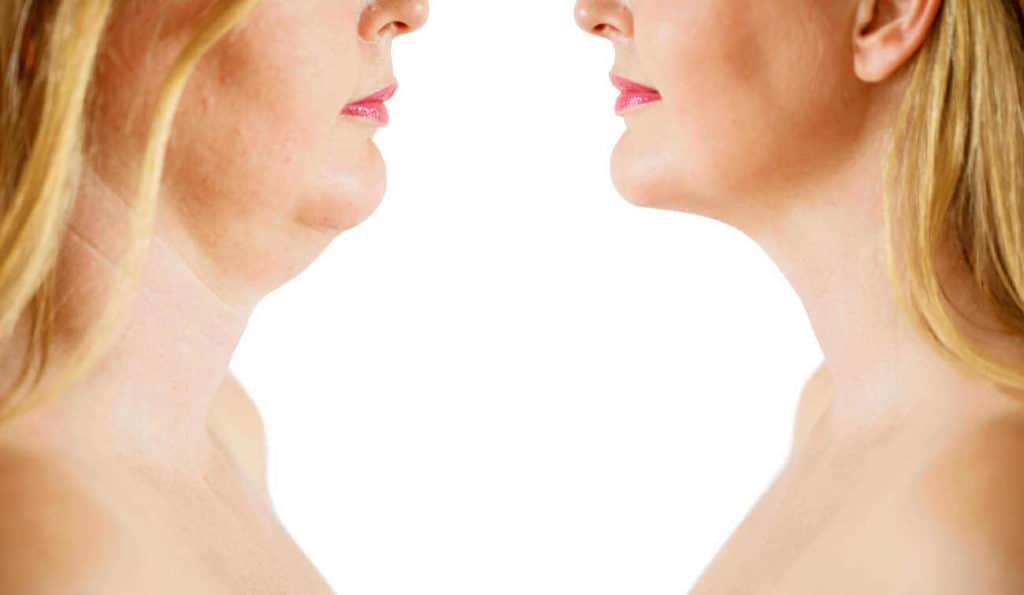 Double Chin treatment Holmes Chapel before and after results