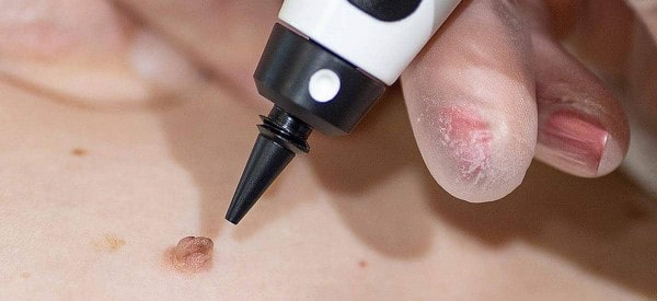 After Skin Tag Removal Holmes Chapel