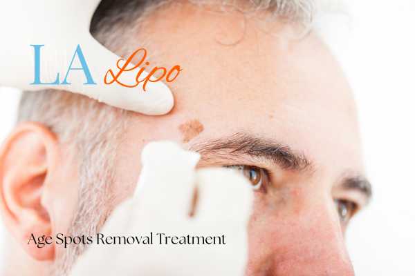 What Are the Most Effective Treatments for Age Spots Holmes Chapel?