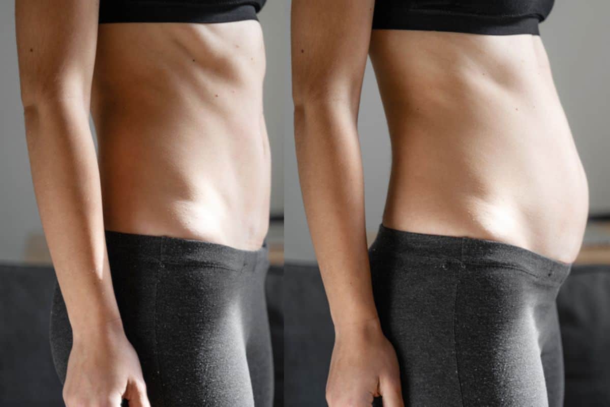 How long does diastasis recti take to improve Holmes Chapel?