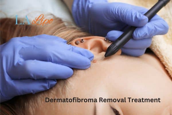Dermatofibroma Removal Treatment Holmes Chapel