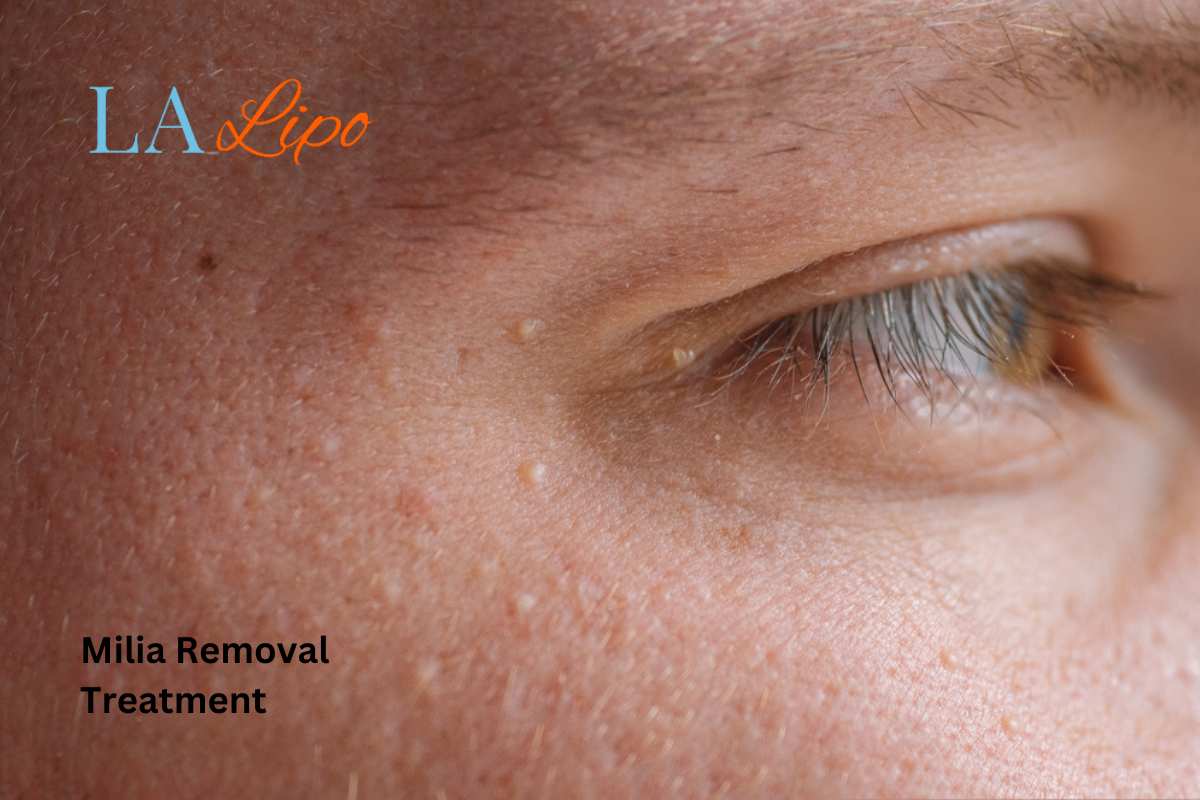 Cryopen Milia Removal: Is It the Easiest and Safest Option Holmes Chapel?