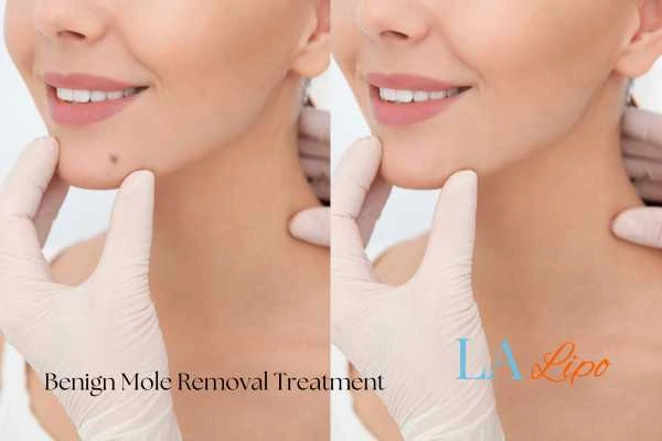 Before-and-after results following benign mole-removal treatment Holmes Chapel