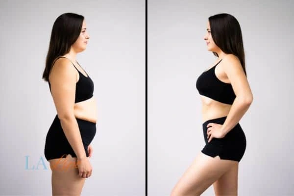 image of woman before and after results of LA-EMS Body Sculpting Holmes Chapel to help treat Diastasis recti