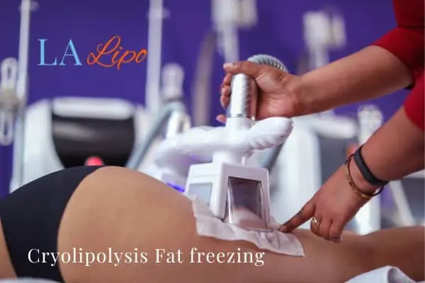 women getting fat freezing Holmes Chapel