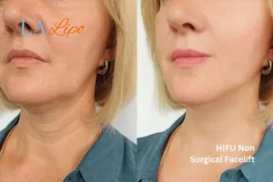 hi-fu for wrinkles Holmes Chapel before and after results