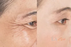 Before and after results of woman - HI-fu wrinkles reduction treatment Holmes Chapel