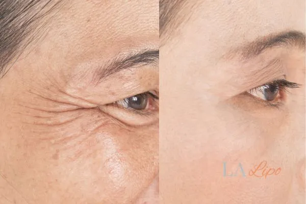 Before and after results of woman - HI-fu wrinkles reduction treatment Holmes Chapel
