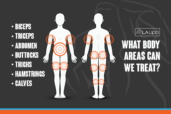 Graphic to show areas you can have LA-EMS Body Sculpting Holmes Chapel treatment.