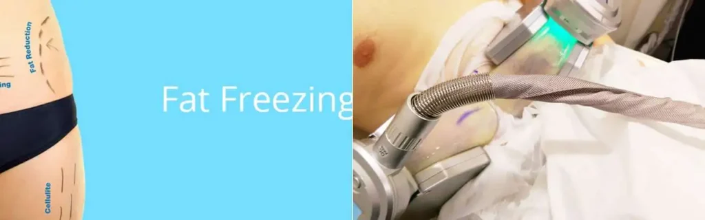 Fat freezing Holmes Chapel on multiple areas of the body