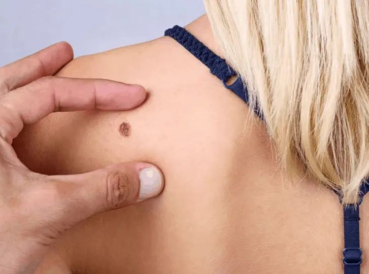 woman having mole removal Holmes Chapel consultation before treatment.