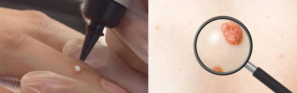 CryoPen practitioner Holmes Chapel assessing a benign mole before treatment