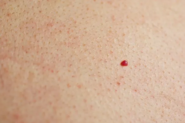 close up of a cherry angioma Holmes Chapel