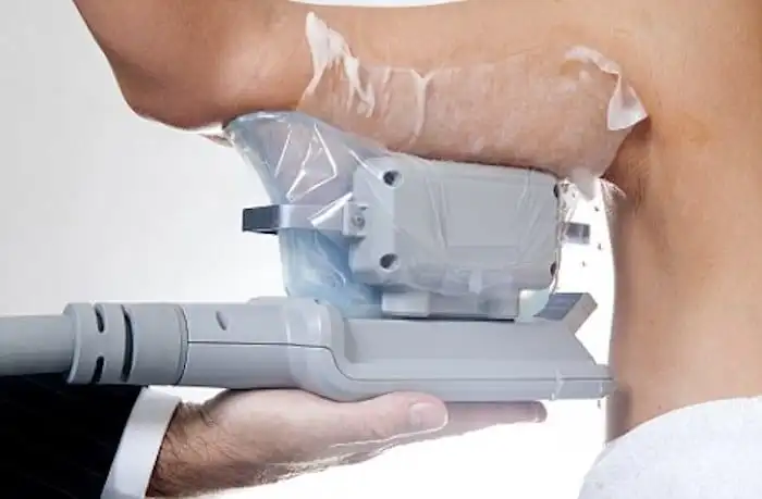 Picture of fat freezing Holmes Chapel on the upper arms.