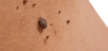 image of a skin tag Holmes Chapel