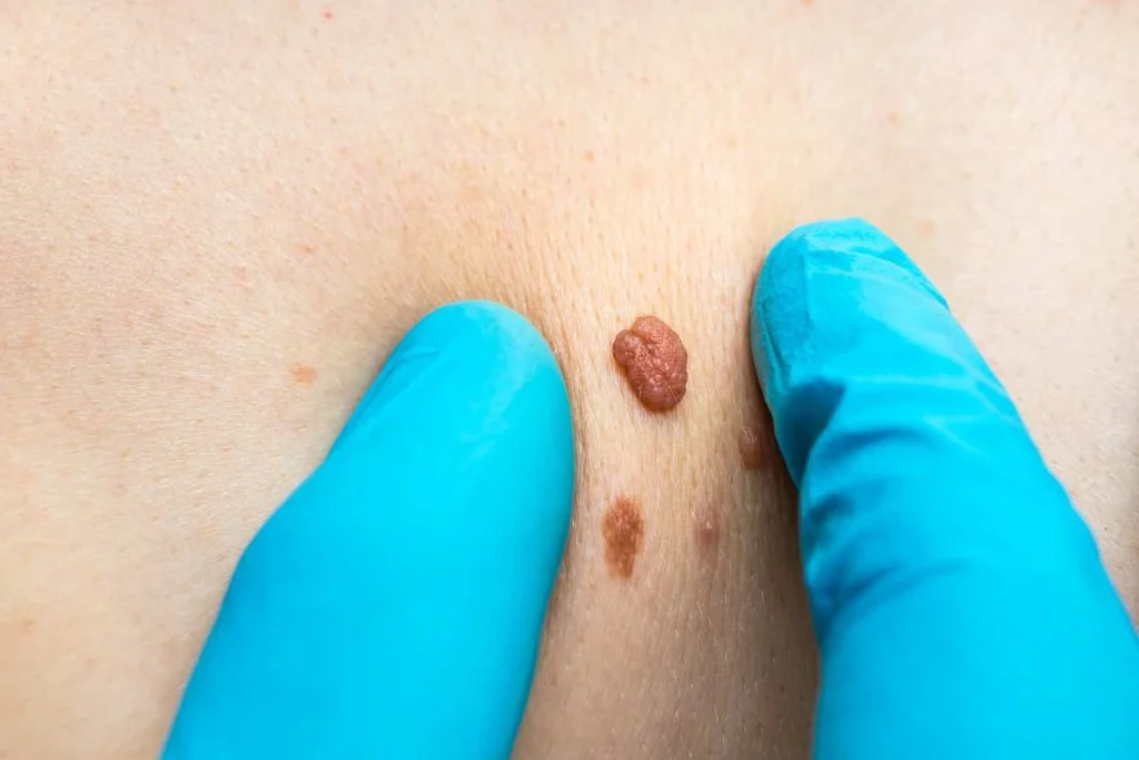 Consultant examining a skin tag Holmes Chapel