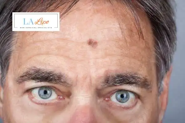 Solar Lentigo Removal Holmes Chapel image of man with mark on his forehead