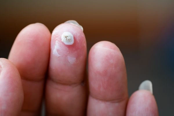 wart on person finger - cryotherapy to treat from LA LIPO Holmes Chapel