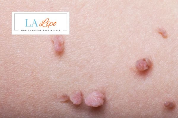 Does cryopen skin tag removal Holmes Chapel hurt? Find out now call our team today!