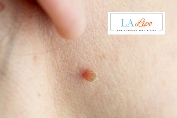 Book skin tag removal Holmes Chapel today speak to our team now!