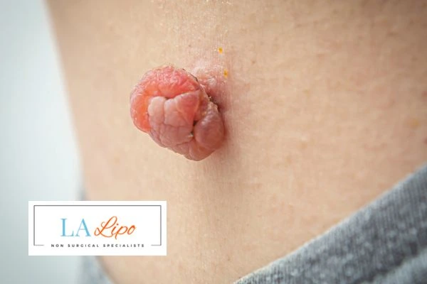 Interested in skin tag removal Holmes Chapel? Concerned about the pain? Find out more today!