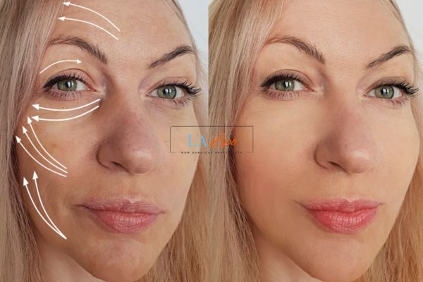 Morpheus 8 results Holmes Chapel face lift.