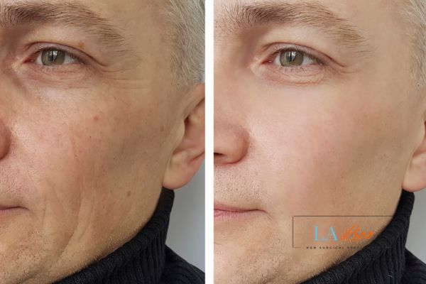 See the amazing results of Morpheus8 Treatment Holmes Chapel!