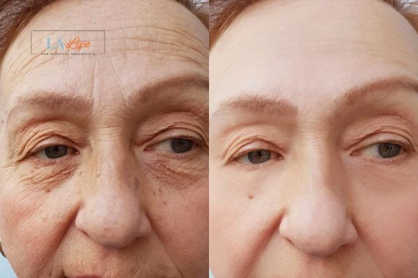 The powerful benefits of Morpheus8 Treatment Holmes Chapel - Call Our team today!