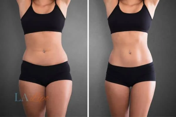 before and after results of non-surgical treatment to help a woman's body image and mental health Holmes Chapel