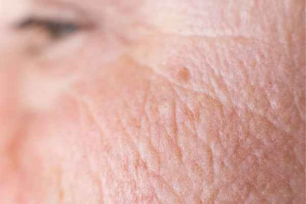 close up picture of a woman's face showing an age spot Holmes Chapel