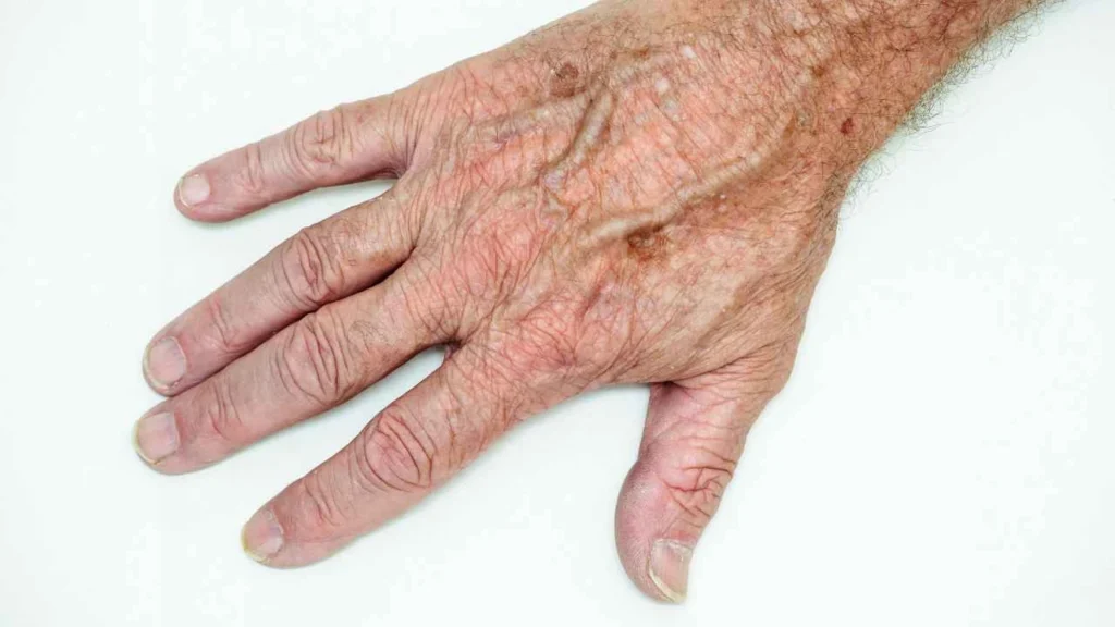 Male hand showing age spot Holmes Chapel