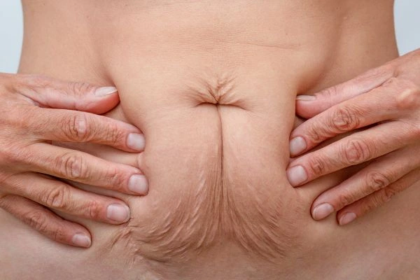 Image of a woman's stomach with loose skin - example of skin tightening Holmes Chapel options