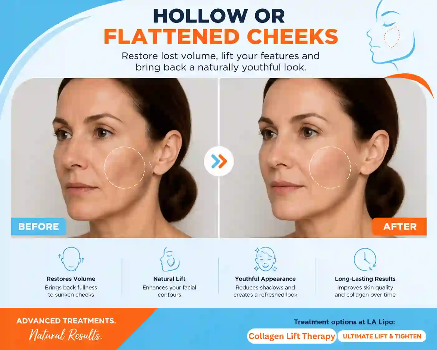 Sign #4: Hollow or Flattened Cheeks Holmes Chapel