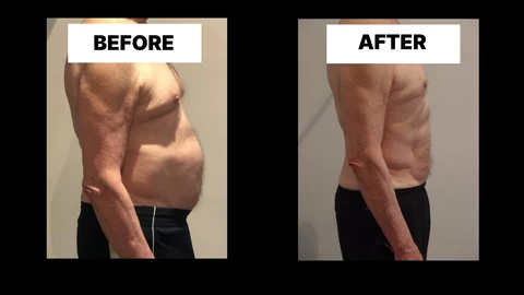 What Symptoms Can Diastasis Recti Cause in Men? Weak Core, Back Pain and Poor Posture Holmes Chapel